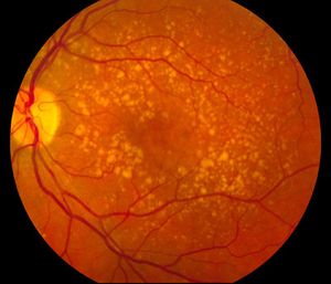 Special Considerations Needed for AMD Patients Undergoing Cataract Surgery