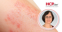 Daxdilimab Improves Discoid Lupus in Phase 2, With Victoria Werth, MD