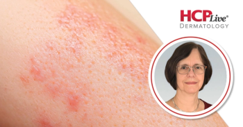 Daxdilimab Improves Discoid Lupus in Phase 2, With Victoria Werth, MD