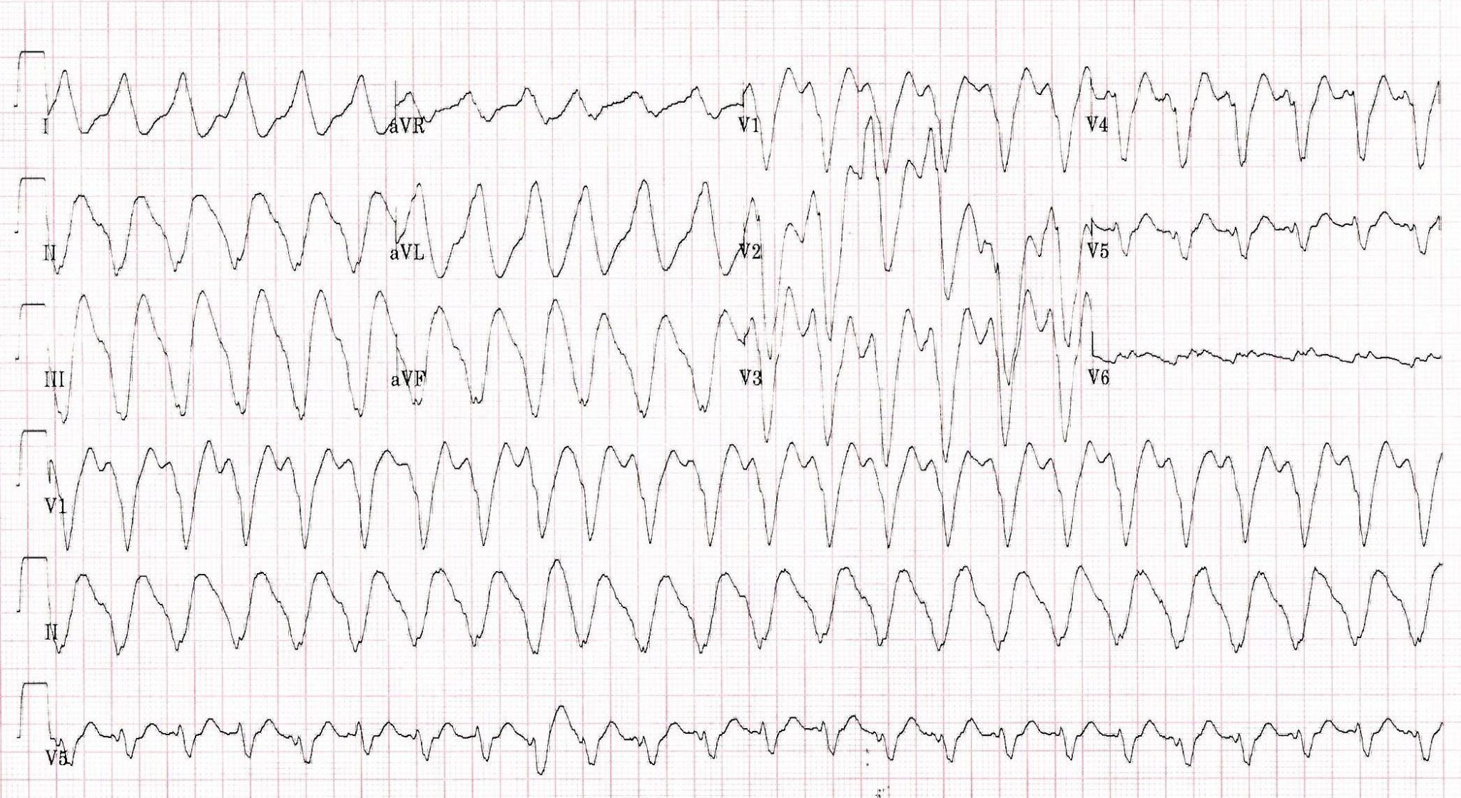 Cardiology Case Report Chest Pain And Palpitations cardiology-case-report-chest-pain-and-palpitations
