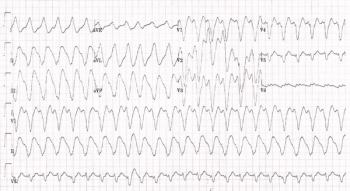 Print out of an EKG strip from a patient with chest pain.| Credit: Brady Pregerson, MD