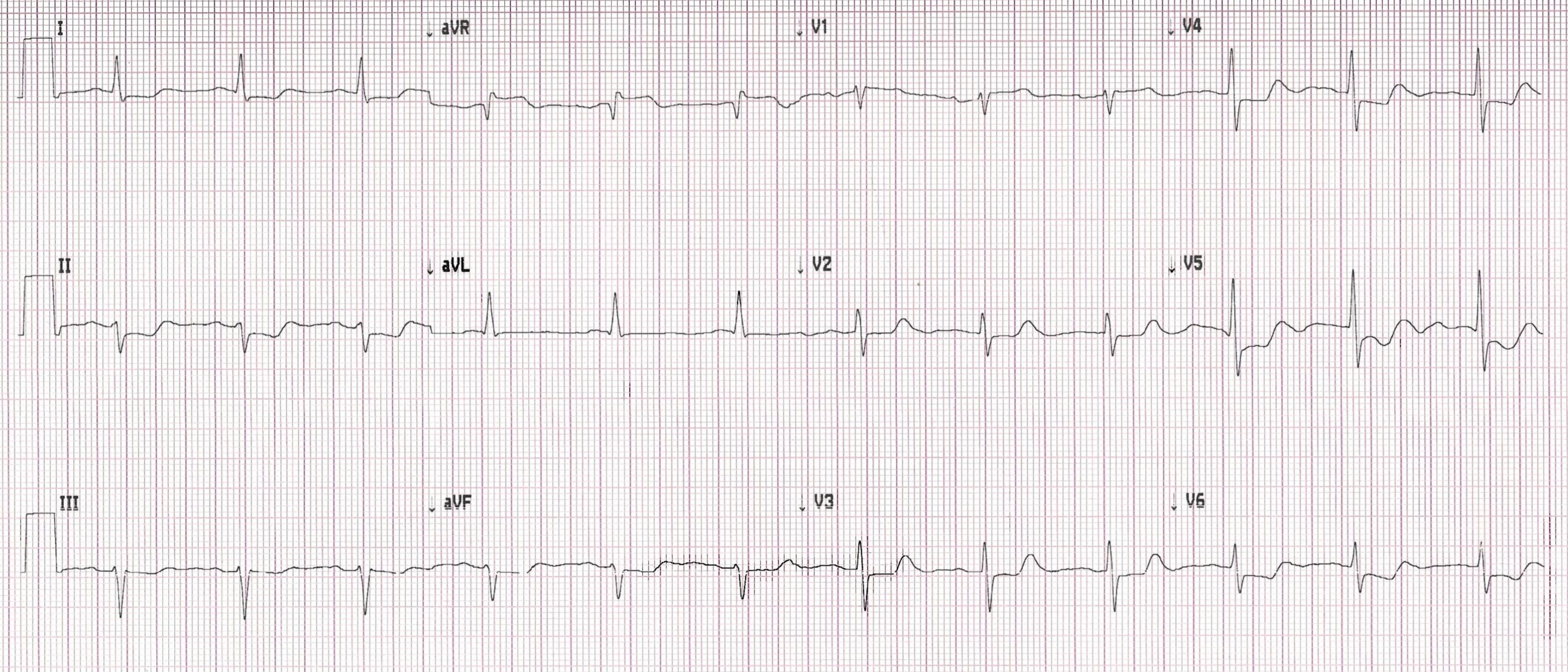 Printout of an ECG from patient featured in case report.