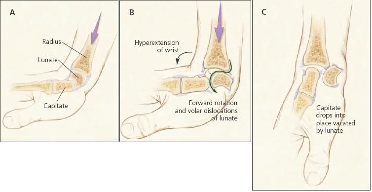 Perilunate dislocation: Case studies of a frequently missed diagnosis
