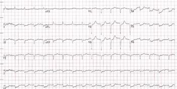 ECG of an elderly patient brought to the hospital with diabetic ketoacidosis