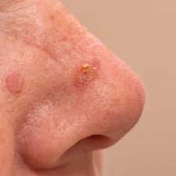 Risk of Cutaneous Squamous Cell Carcinoma Higher in Patients with AK