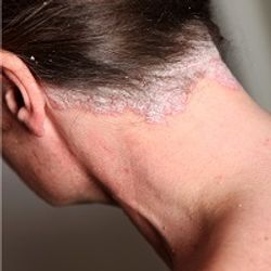 Apremilast Improves Outcomes in Scalp Psoriasis 