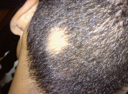 JAK1 Inhibitors Found to Resolve Inflammation, Restore Hair Growth for Alopecia Areata