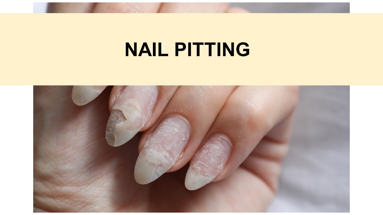 Nail signs of Disease | Nail pitting | Finger clubbing | Signs of anemia |  Terry's nails - YouTube