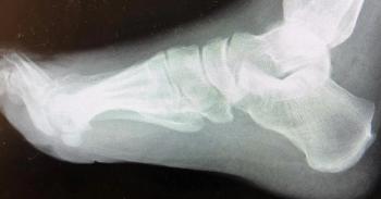 Plain film of a foot