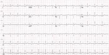 EKG