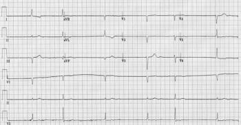 EKG of an older women with an arrhythmia