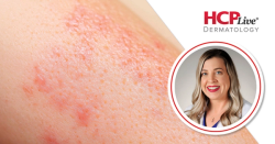 Tapinarof Cream 1% Improves Sleep in Atopic Dermatitis, With Druhan Howell, MD