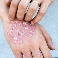 Apremilast Monotherapy Effective in Moderate to Severe Plaque Psoriasis