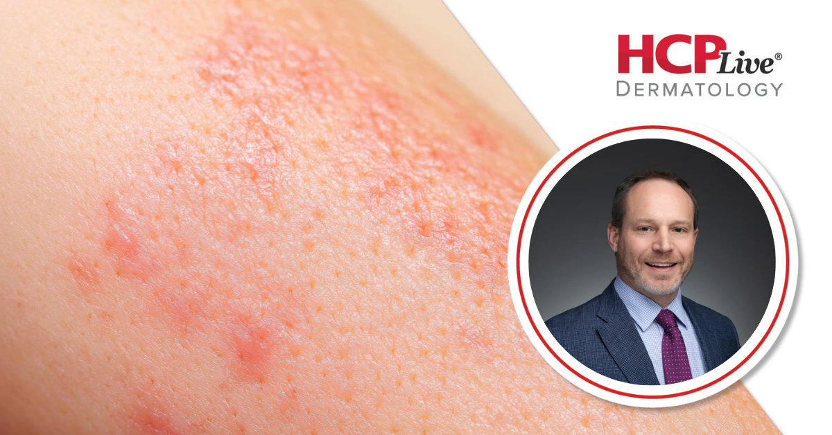 Positive Signals for Bispecific and Trispecific Antibodies in Atopic Dermatitis, With Christopher Bunick, MD, PhD