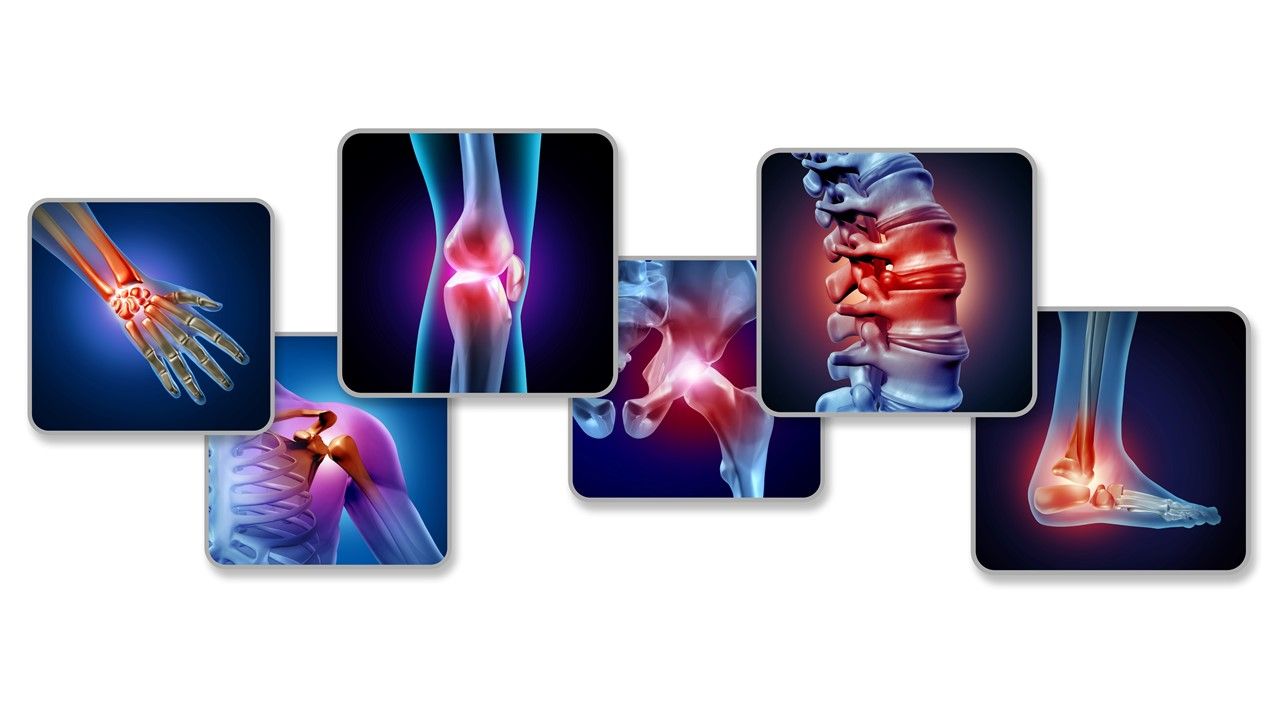 Psoriatic Arthritis Quiz What are the five forms of PsA?