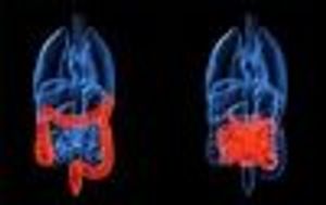 New Stem Cell Therapy May Treat Crohn's Disease