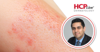 Q&A: Insights on New Lebrikizumab Findings for Hand and Foot Atopic Dermatitis