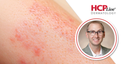 HLA-A*32:01 Linked to Lamotrigine DRESS Risk, With Matthew Krantz, MD