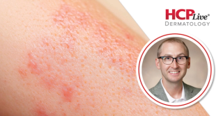 HLA-A*32:01 Carrier Screening Feasibility Before Lamotrigine, With Matthew Krantz, MD