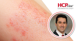 Q&A: Gene Expression Testing, Ameluz PDT, and the Psoriasis Pipeline