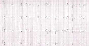 Computer printout of an ECG | Credit: Brady Pregerson, MD