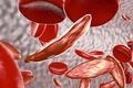 The State of Gene and Cell Therapy for Sickle Cell Disease