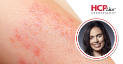 Real-World Data Reveal Gaps in Vitiligo Treatment, With Genevieve Gauthier, MSc
