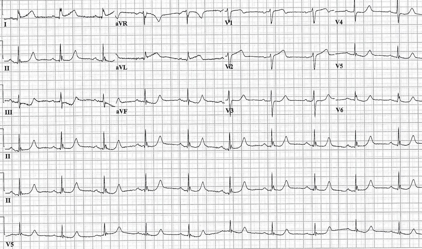 ECG printout of a patient experiencing chest pain as a result of occlusion myocardial infarction.