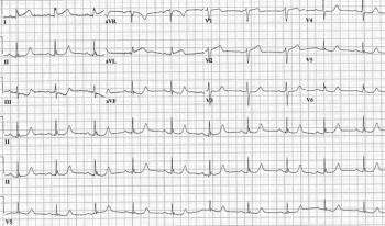 ECG printout of a patient experiencing chest pain as a result of occlusion myocardial infarction.