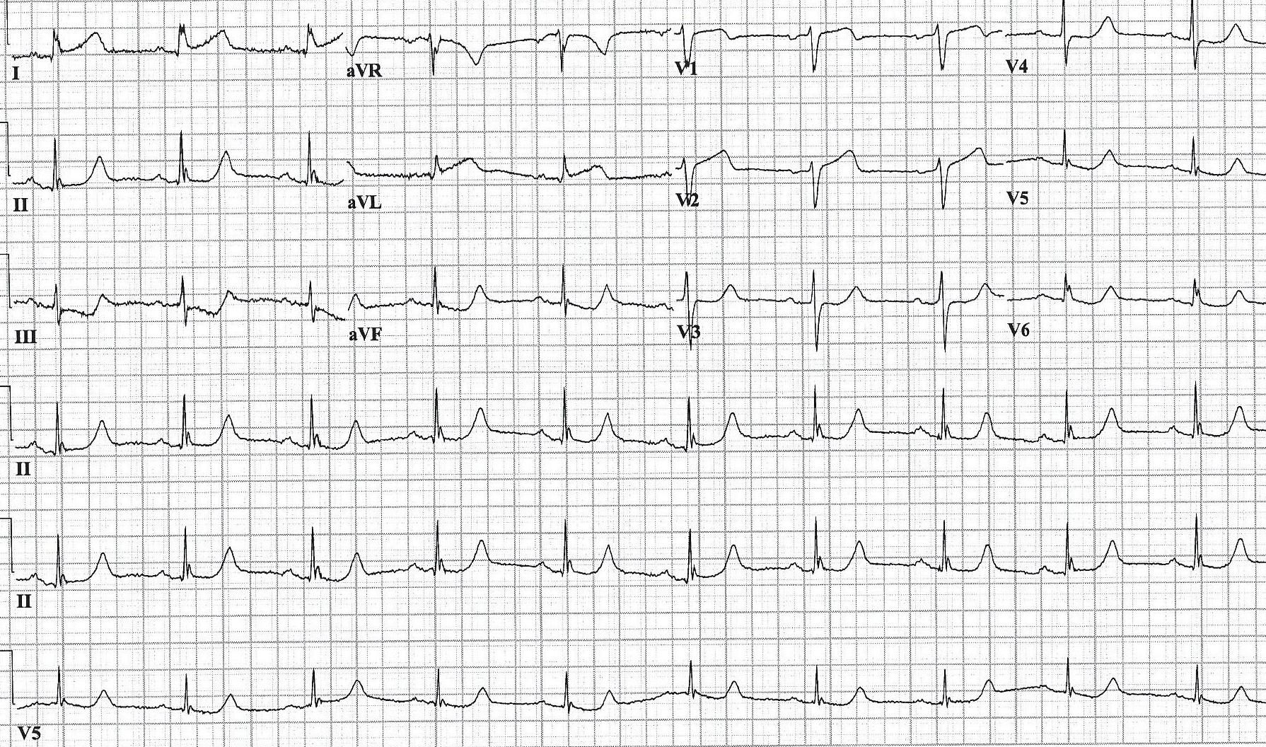 Cardiology Case Report: Waxing and Waning Chest Pain