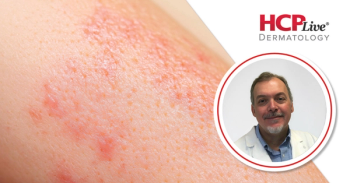 Rezpegaldesleukin Shows Promise for AD, Comorbid Asthma, With Jonathan Corren, MD