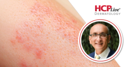 Why Molluscum No Longer Means Watch and Wait, With Leon Kircik, MD