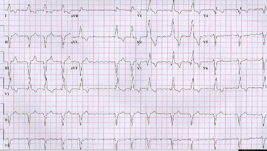 hyperkalemia ekg