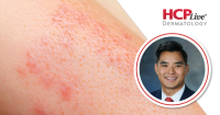 Q&A: Looking Beyond Body Surface Area in Atopic Dermatitis Treatment Selection