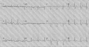 ECG computer readout of a person experiencing a heart attack. | Credit: Bardy Pregerson, MD