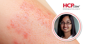 Discussing Nutrition's Role in Psoriasis Management, With Rajani Katta, MD