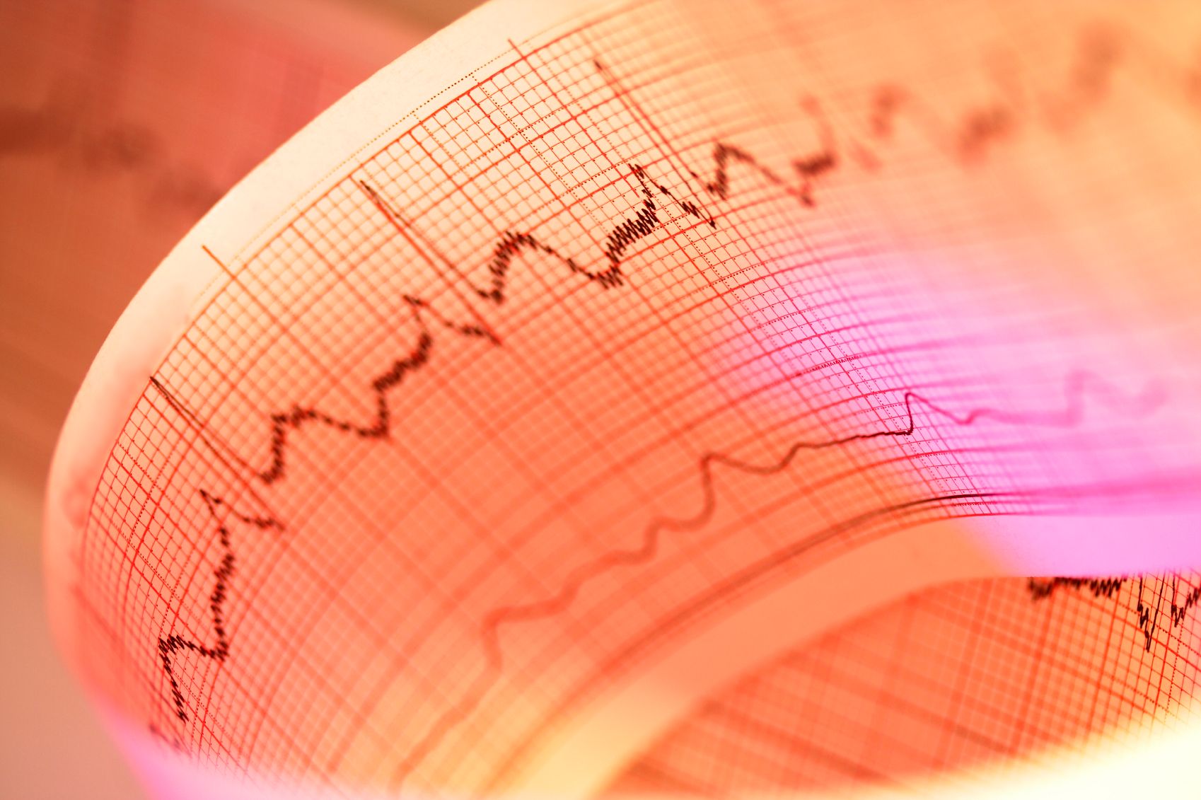 EKG strip displaying an arrhythmia