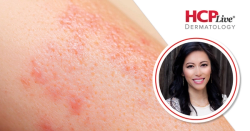 TRACE: Tralokinumab Data for Atopic Dermatitis in Skin of Color, With April Armstrong, MD, MPH