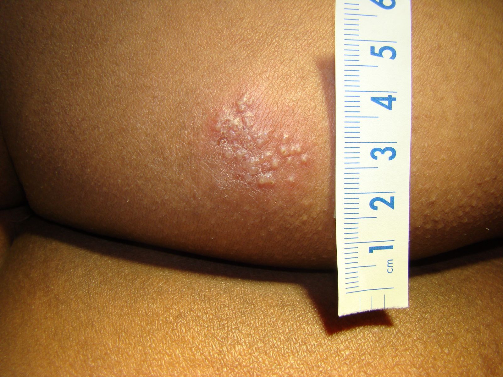 Painful Buttock Lesion In A Pregnant Woman
