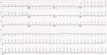 ECG printout of a patient with chest pain. | Credit: Brady Pregerson, MD