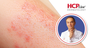 Oral GP-SOD for Vitiligo: Safety Profile, Dosing, and What's Next