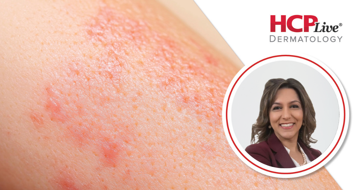 Clinical Pearls on IL-13 Inhibitors in Atopic Dermatitis, With Mona Shahriari, MD