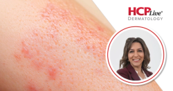 A Visual Guide to Diagnosing Prurigo Nodularis in Skin of Color, With Mona Shahriari, MD
