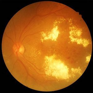 Hypertensive Retinopathy Positively Correlated with Albuminuria in Analysis