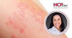 AAD 2026: Owning Psoriatic Disease, With Lindsay Ackerman, MD