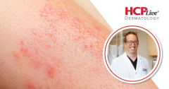 Corticosteroid Stewardship in Dermatology is Not Steroid Avoidance, With Adam Friedman, MD