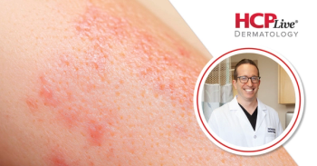 Corticosteroid Stewardship in Dermatology is Not Steroid Avoidance, With Adam Friedman, MD