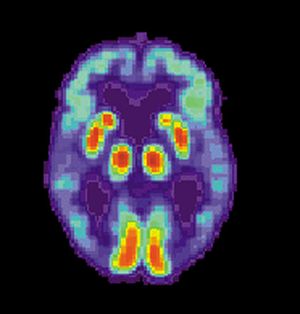 Alzheimer's Treatment Prevents and Improves Neurological Damage on Mouse Model