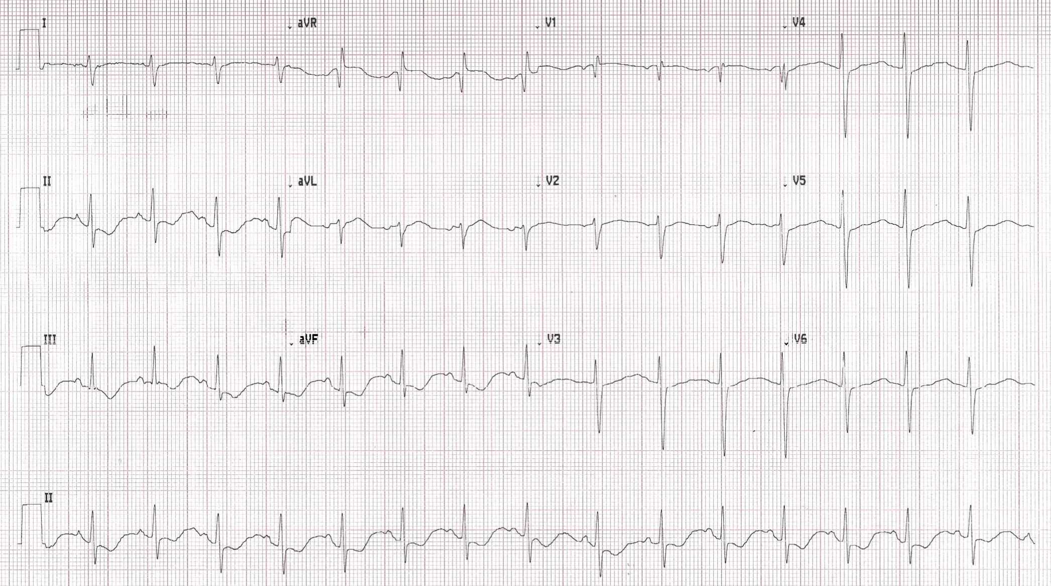 Computer print out of patient ECG. | Credit: Brady Pregerson, MD