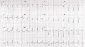Computer print out of patient ECG. | Credit: Brady Pregerson, MD